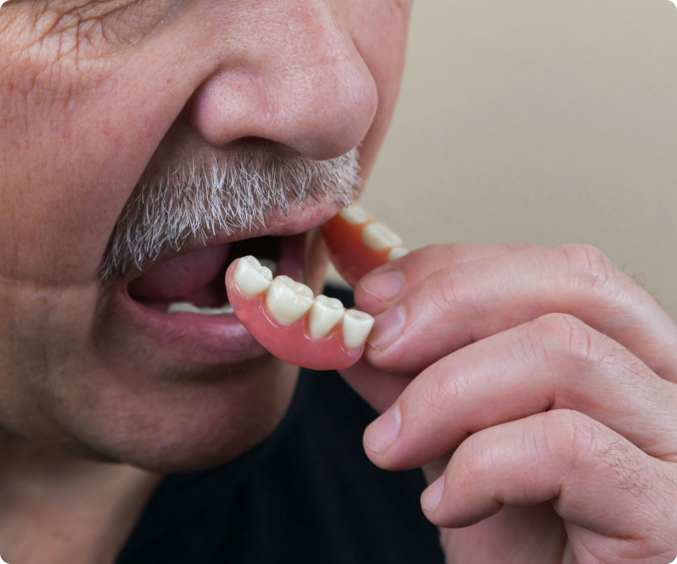 Imagem do procedimento de prótese dentária