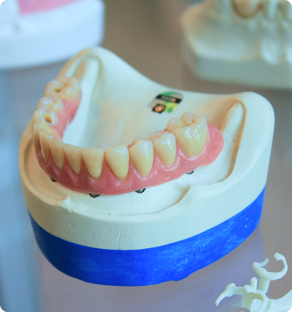 Imagem de prótese dentária