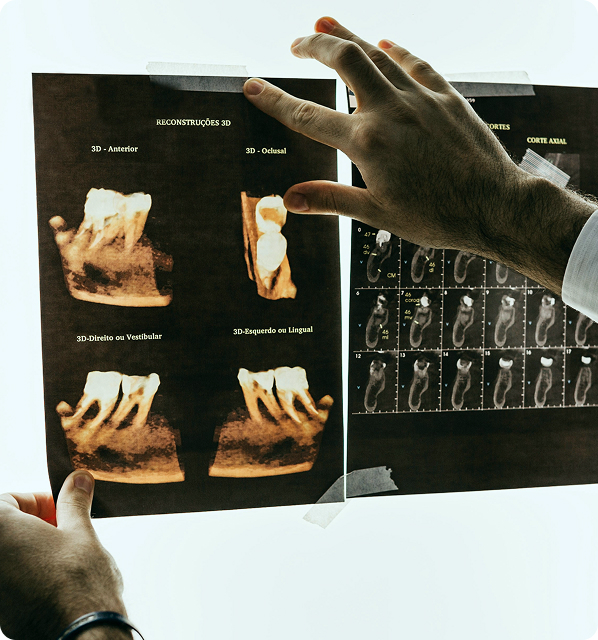 Imagem de Exodontia